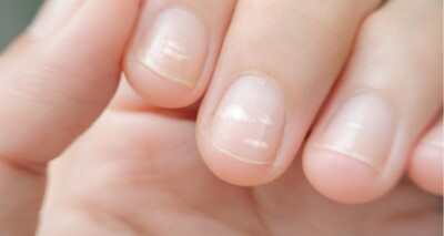 Стан нігтів може говорити про серйозні захворювання